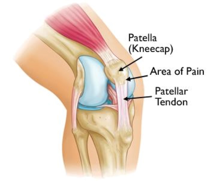Patellar tendonitis [cure]  Trustworthy SG Knee Clinic