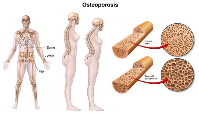 A csontritkulás és osteoarthritis közötti különbség A különbség